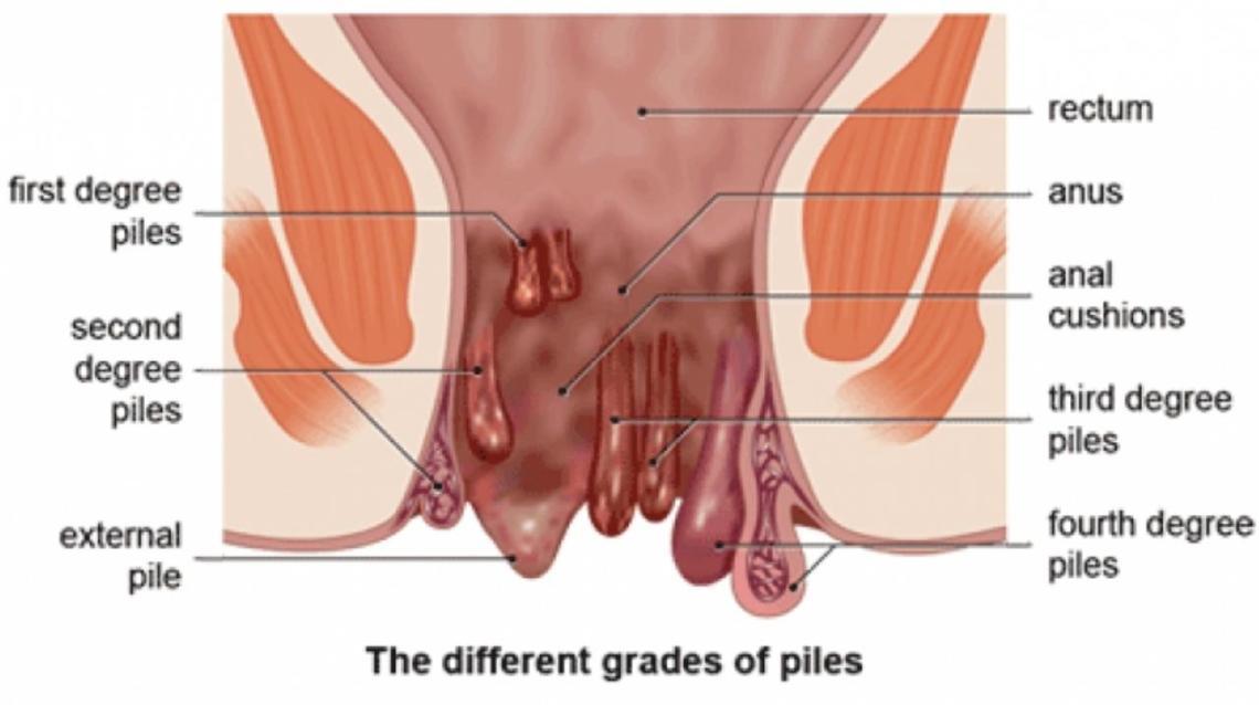 Piles Hemorrhoid - I&#39;ve Been Suffering From Piles.. Though | Practo Consult