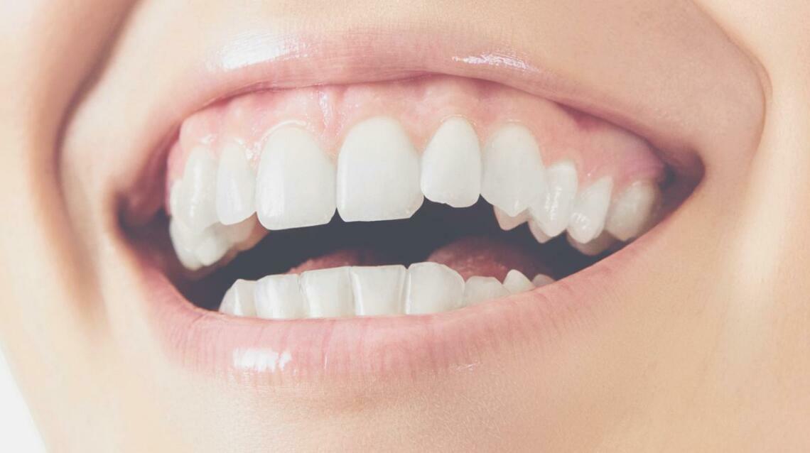 Braces for Crooked Teeth?