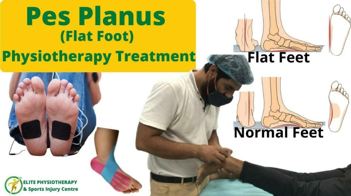 Pes Planus Flat Foot Physiotherapy Treatment