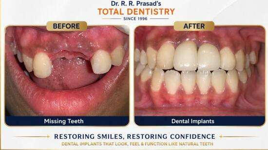 Missing Teeth? Restore Your Smile With Dental Implants