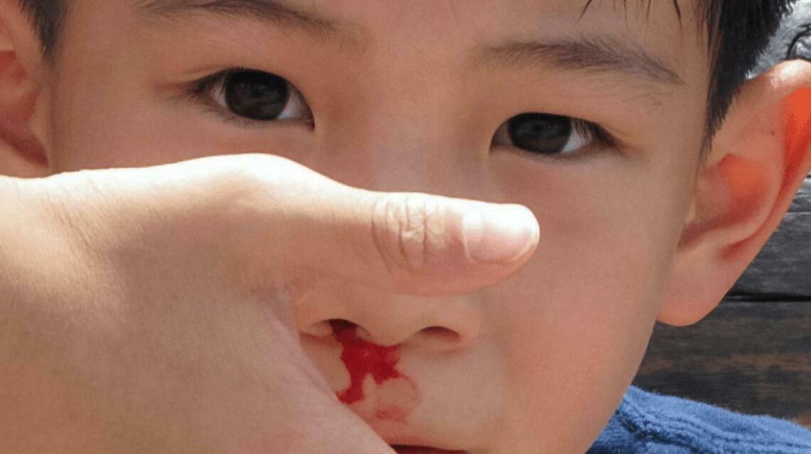 Why Do Children Get Nosebleeds Frequently?