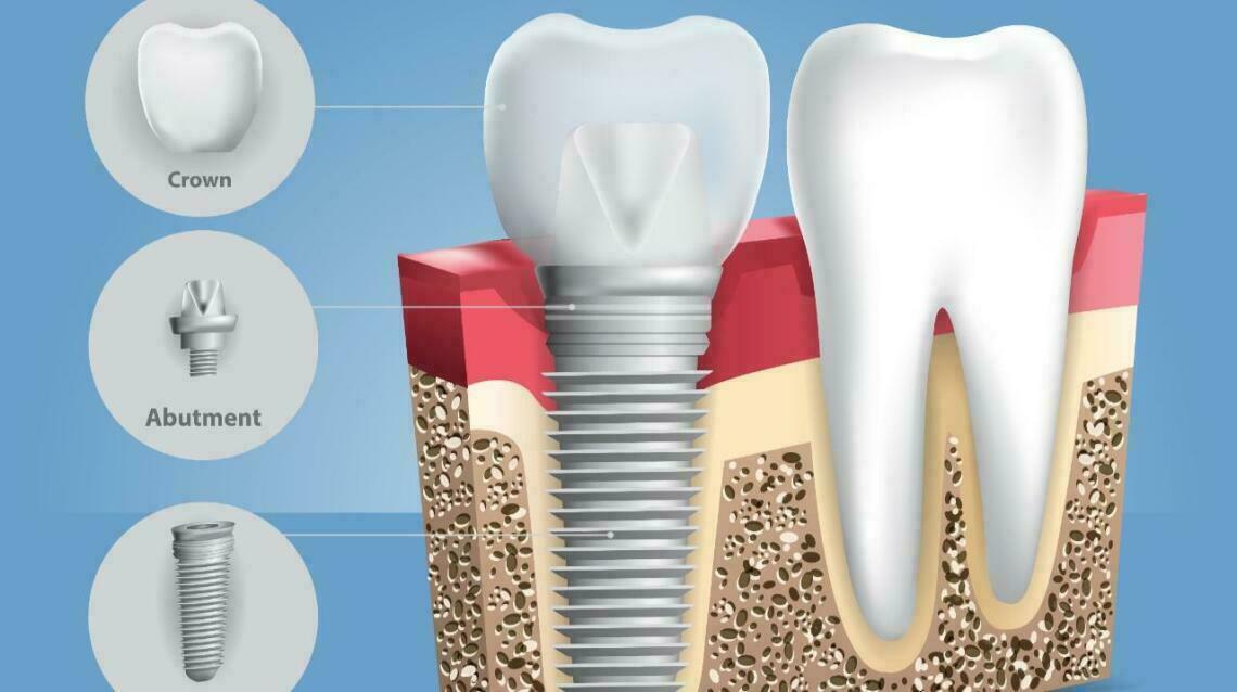 Are Dental Implants Safe?