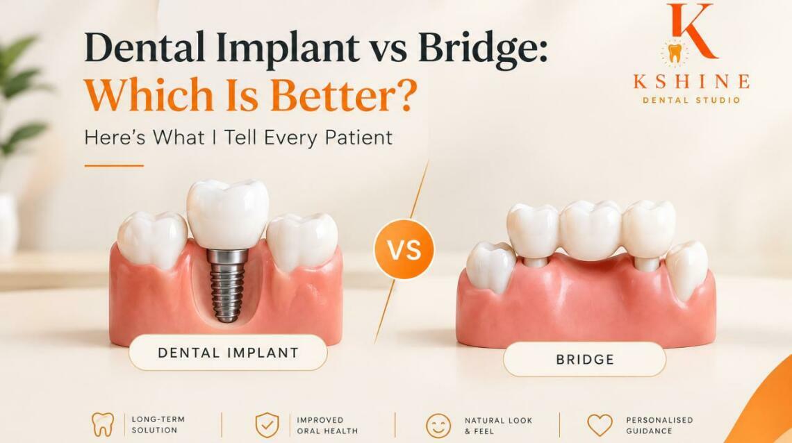 Dental Implant vs Bridge: Which Is Better?  Here’s What I Tell Every Patient