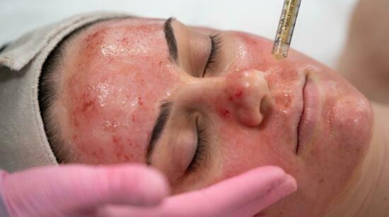 All You Need to Know About : Vampire Facials