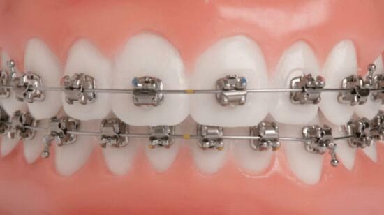 5 Reasons to Opt for Self Ligating Braces