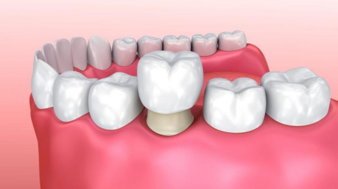 Types of Dental Crown- Cap and Bridge