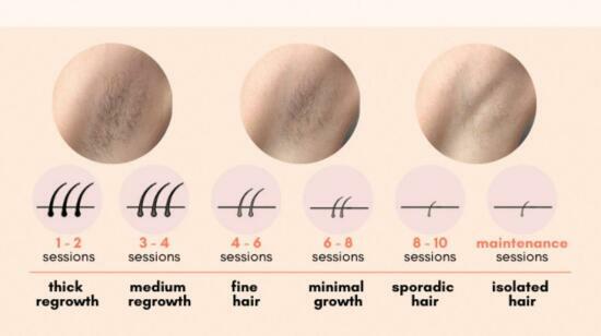 Laser Hair Reduction : Why Some Patients Need More Sessions Than Others.