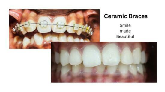 Ceramic Braces:- Smile Correction With Orthodontic Treatment.