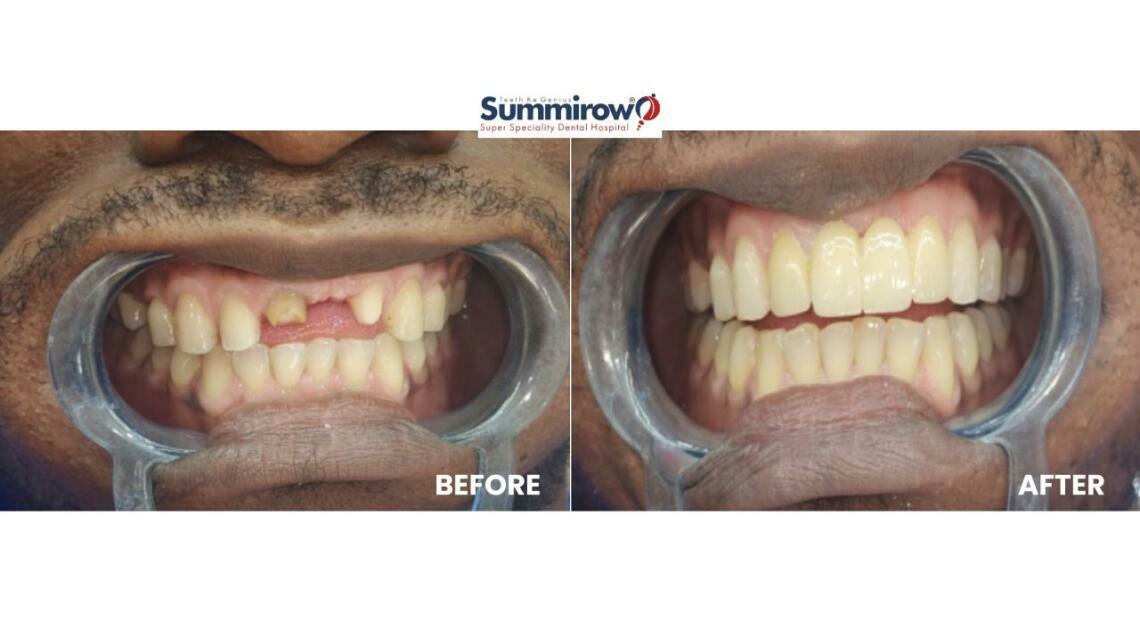 Smile Rehabilitation With Esthetic Crown and Veneer Replacement