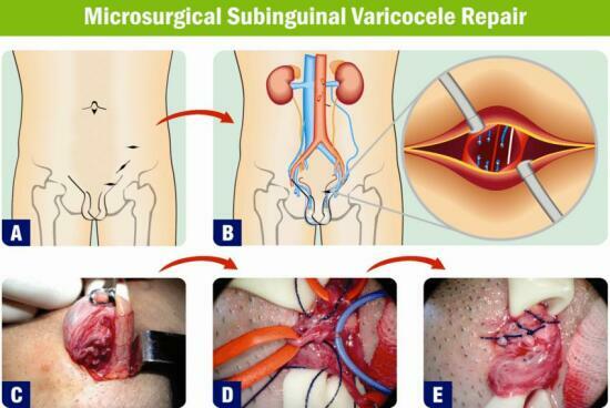 Varicocele: Most Common Cause of Male Infertility
