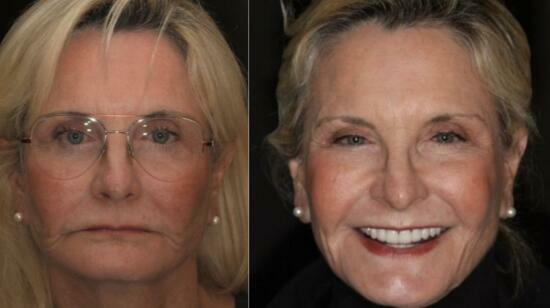 The Investment in Anti-Aging Dentistry