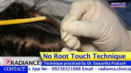 The No-Root Touch Hair Transplant at Radiance Clinic"