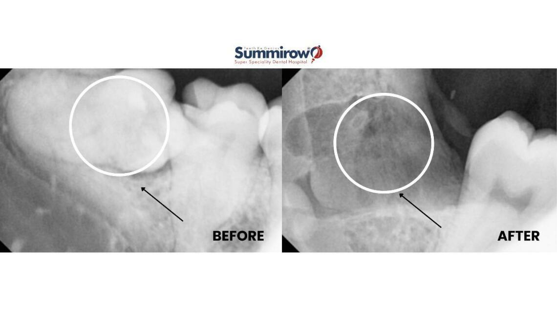 Surgical Extraction of Impacted Wisdom Tooth (48) With Pericoronitis