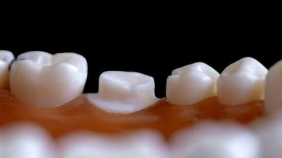 9 Must-Know Secrets About Dental Crowns and Bridges for Perfect Teeth