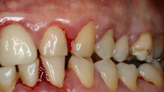 5 Early Warning Signs of Gum Disease You Should Never Ignore