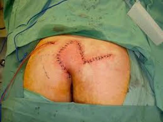 Pilonidal Sinus Recent Limberg Flap Technique