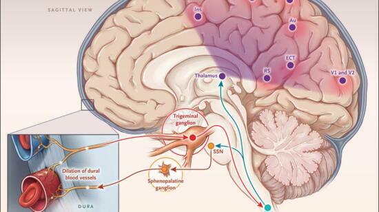 Migraine, Why You Suffer?