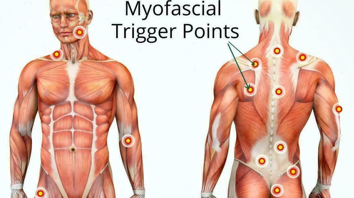 Steroid Injection for Trigger Points. the Truth!