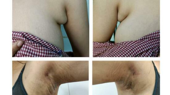 Say Goodbye to Unwanted Axillary Breast Bulge With Scarless Liposuction!