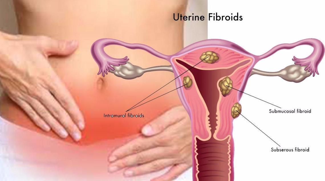 Резултат слика за submucosal uterine fibroid