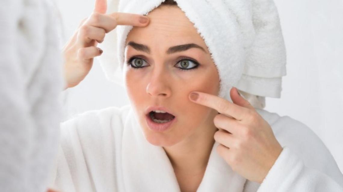 Quick Tips to deal with Acne