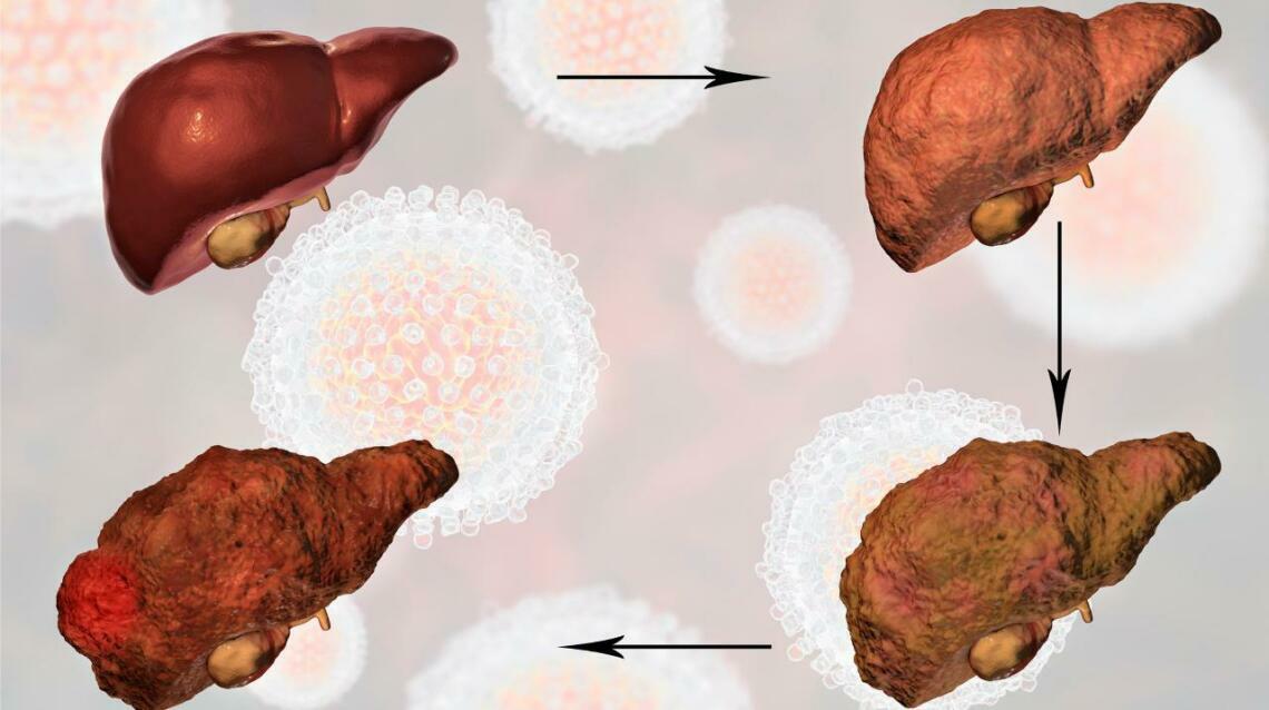 Fatty Liver Reversal - Guinea Pig Fatty Liver Disease Reversal