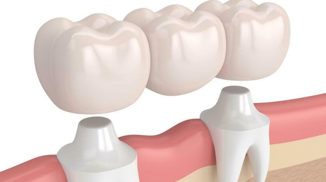 Dental Crowns and Bridges