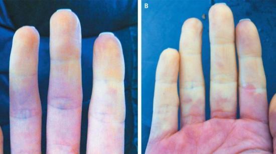 Swelling, Coldness of Fingers in Winter-Do's and Don't and Homoeopathic Approach
