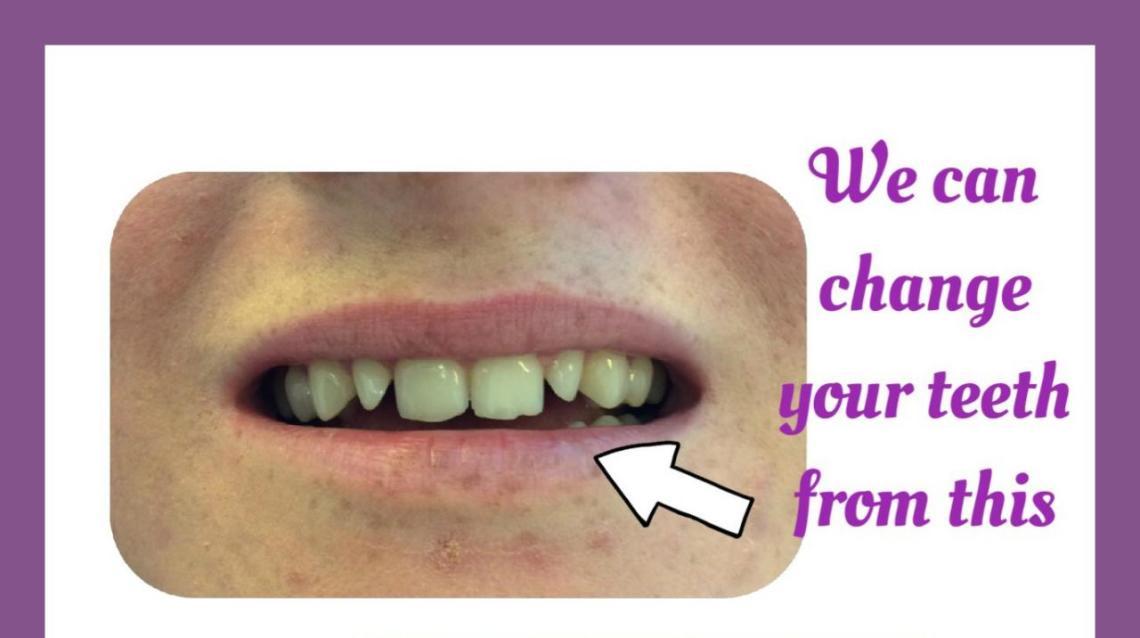 Beautification of Teeth With Composites