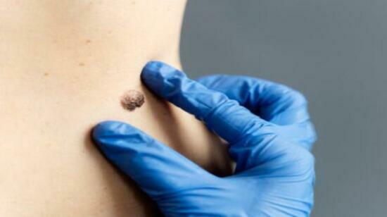 Where Can I Get Painless Wart Removal Treatment