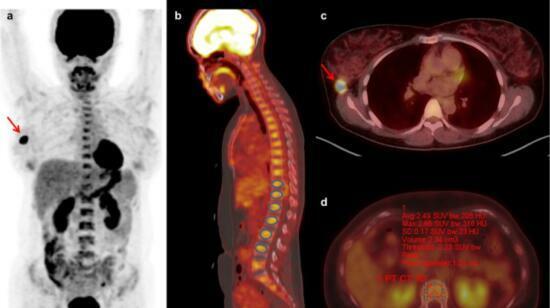 Importance of Pet-Ct in Diagnosing Cancer