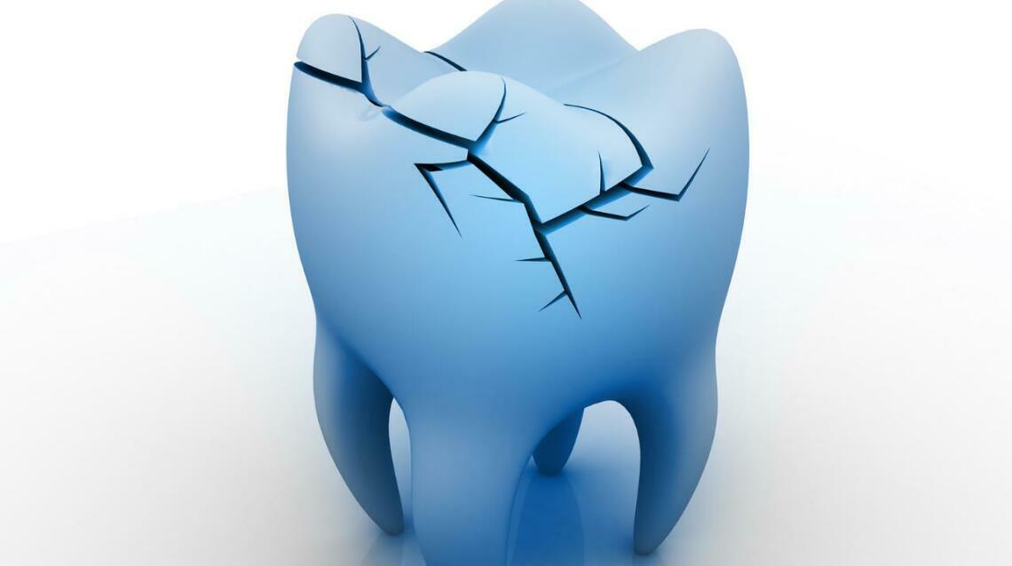 Single-Sitting Rct vs. Traditional Root Canal: Which One Do You Actually Need?
