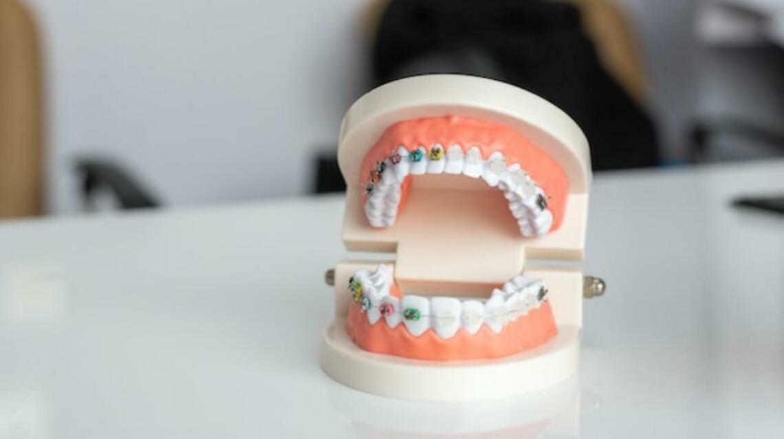 "Why You Need Elastics/rubber Bands for Dental Braces /Invisalign Clear Aligners?"