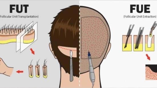 Why Should You Choose Bio-Enhanced Hair Transplant