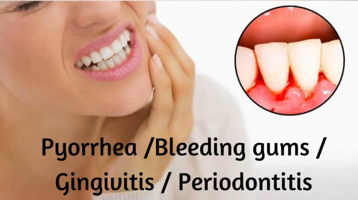 Pyorrhea /Bleeding Gums / Gingivitis / Periodontitis