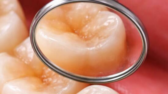 Her Old Silver Fillings Looked Unattractive