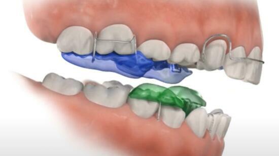 Myofunctional Appliances: Tiny Tools for Big Smiles