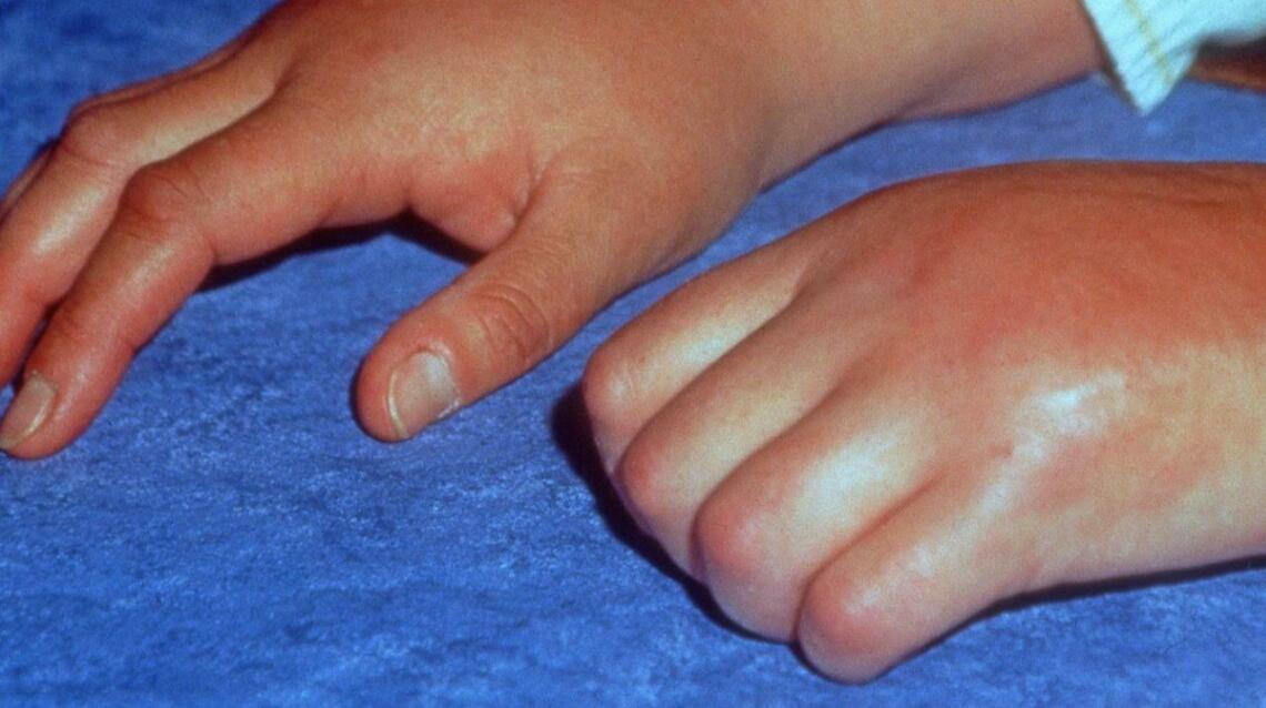 Complex Regional Pain Syndrome (Crps), a Rare but Severe Disease