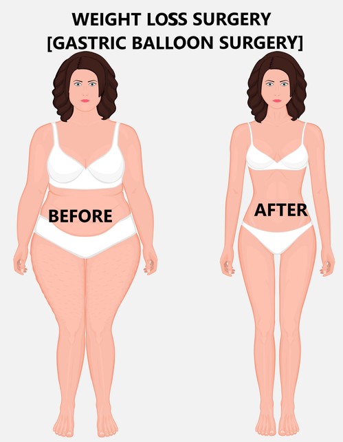 Weight Loss Surgery In India